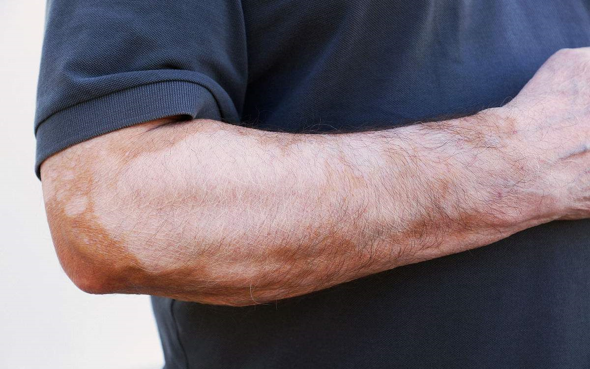 甲醛超標和白癜風有關系嗎？裝修污染對人體影響極大！